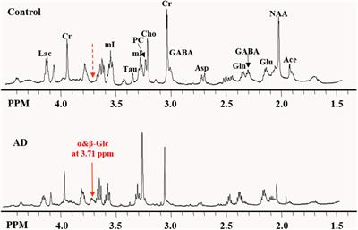 Metabolite Profile of Alzheimer’s Disease in the Frontal Cortex as Analyzed by HRMAS 1H NMR